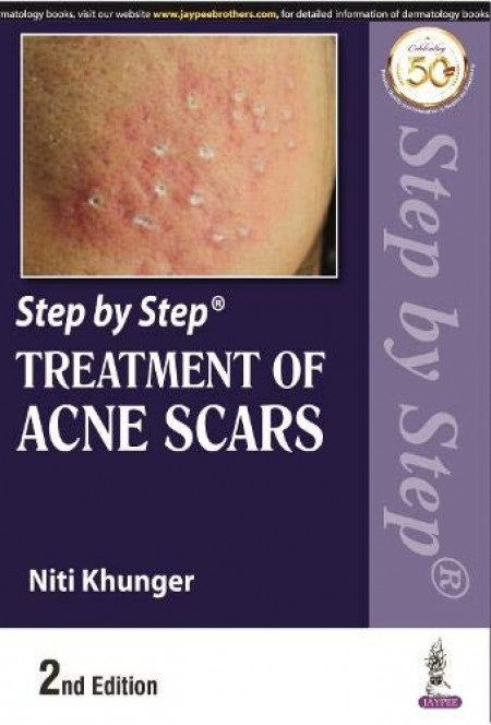 Step by Step Treatment of Acne Scars
