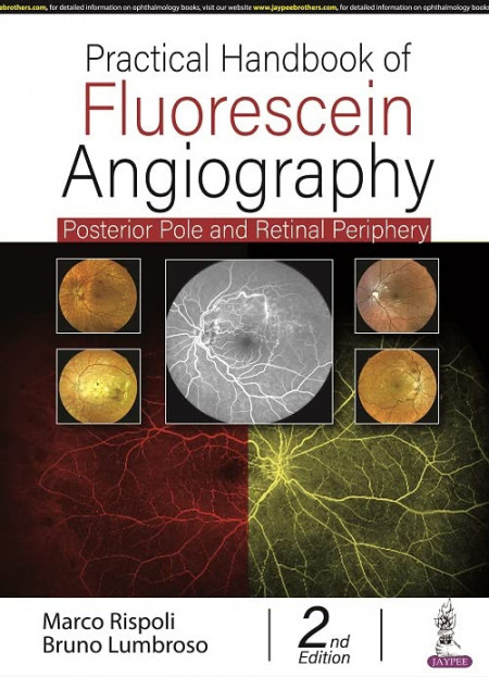 Practical Handbook of Fluorescein Angiography: Posterior and Retinal Periphery