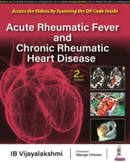 Acute Rheumatic Fever And Chronic Rheumatic Heart Disease 2nd/2023